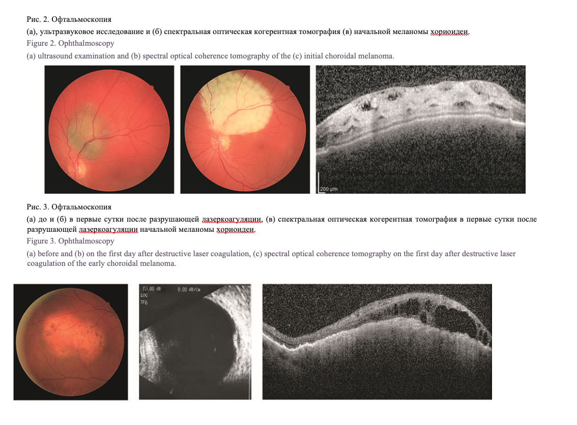 Мрт меланомы. Меланома хориоидеи гистология. Меланома хориоидеи морфология. Металлический рефлекс хориоидеи.