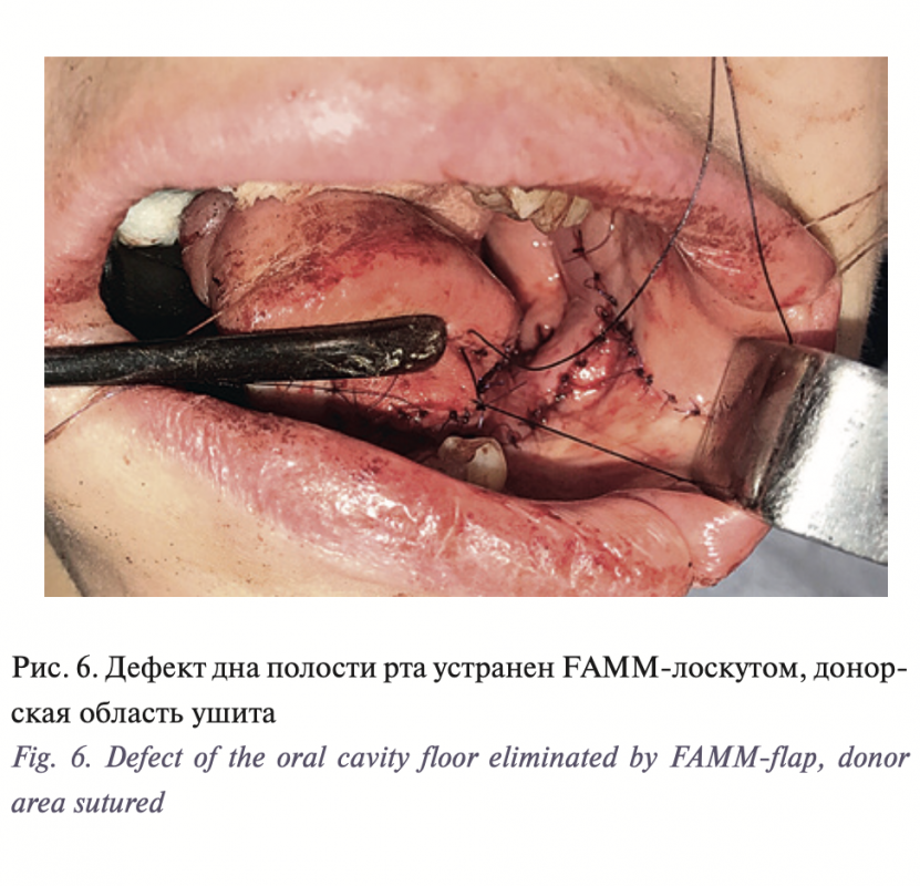 View of the large craniotomy through a left-sided question-mark-shaped   Download Scientific Diagram